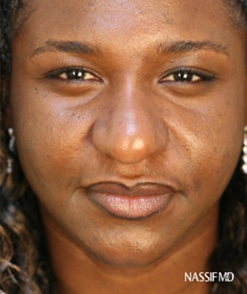 Primary Rhinoplasty Before & After Gallery - Patient 108171683 - Image 3