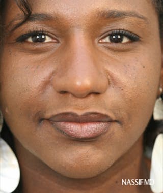 Primary Rhinoplasty Before & After Gallery - Patient 108171683 - Image 4