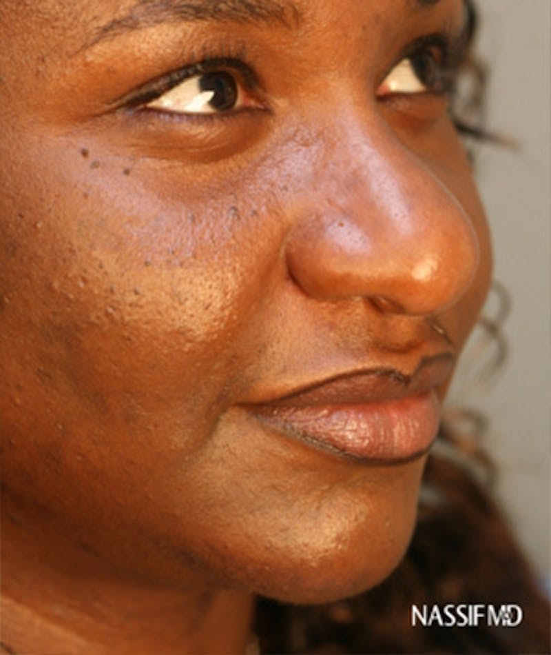 Primary Rhinoplasty Before & After Gallery - Patient 108171683 - Image 5