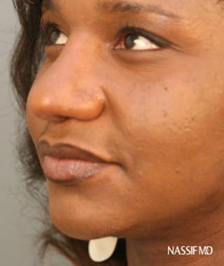 Primary Rhinoplasty Before & After Gallery - Patient 108171683 - Image 8