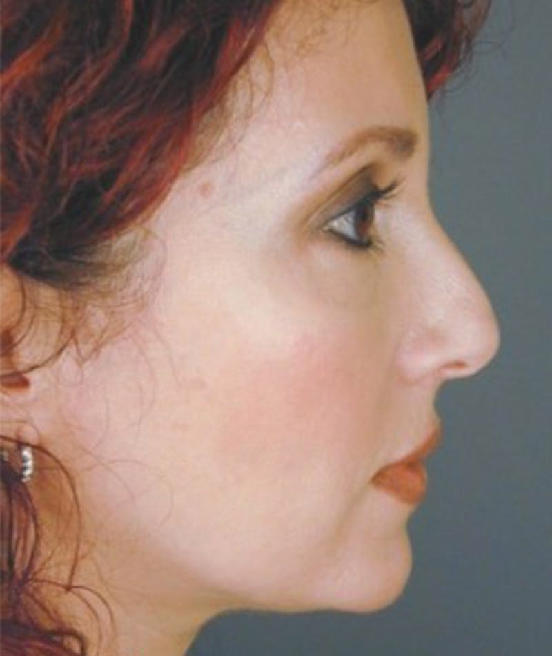 Primary Rhinoplasty Before & After Gallery - Patient 108171707 - Image 1