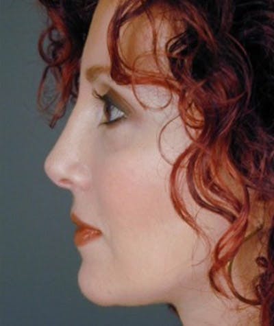 Primary Rhinoplasty Before & After Gallery - Patient 108171707 - Image 2