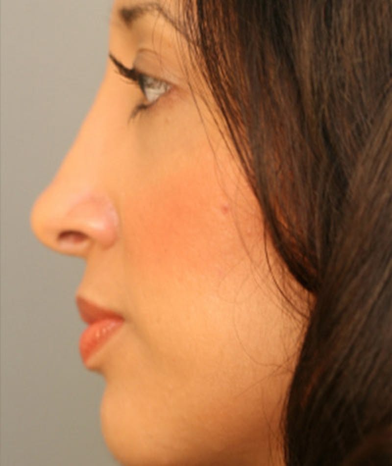 Primary Rhinoplasty Before & After Gallery - Patient 108171708 - Image 2