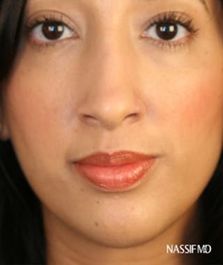 Primary Rhinoplasty Before & After Gallery - Patient 108171708 - Image 4