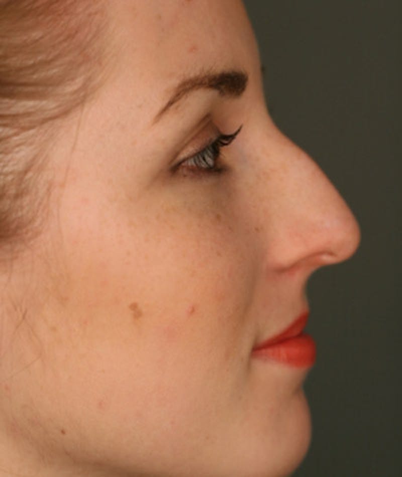 Primary Rhinoplasty Before & After Gallery - Patient 108174133 - Image 1