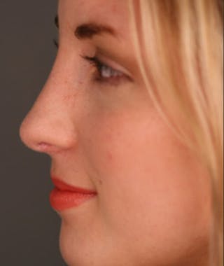 Primary Rhinoplasty Before & After Gallery - Patient 108174133 - Image 2