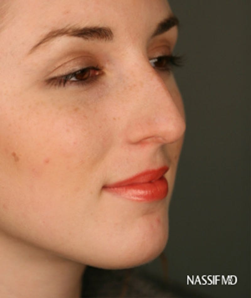 Primary Rhinoplasty Before & After Gallery - Patient 108174133 - Image 3