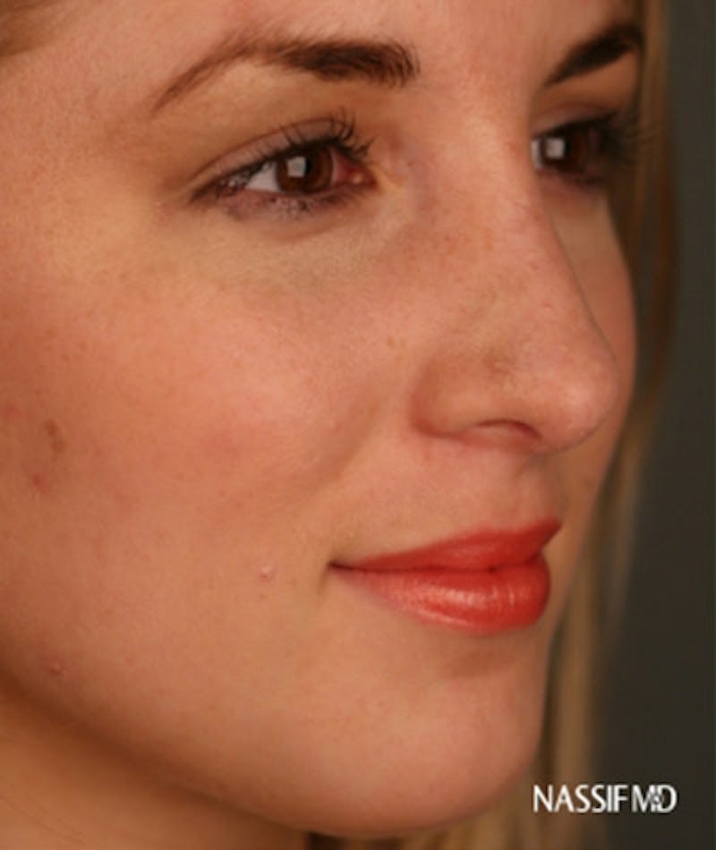 Primary Rhinoplasty Before & After Gallery - Patient 108174133 - Image 4