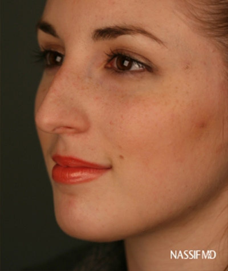 Primary Rhinoplasty Before & After Gallery - Patient 108174133 - Image 5