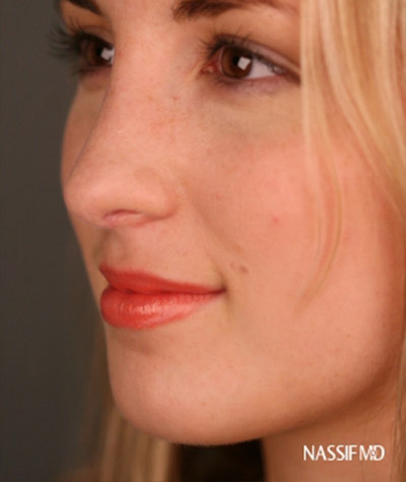 Primary Rhinoplasty Before & After Gallery - Patient 108174133 - Image 6