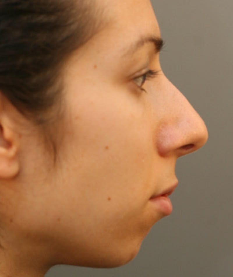 Primary Rhinoplasty Before & After Gallery - Patient 108174135 - Image 1