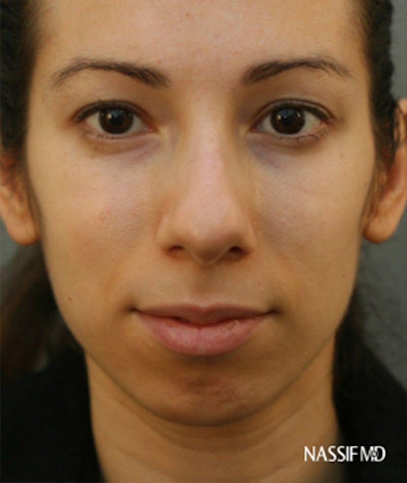 Primary Rhinoplasty Before & After Gallery - Patient 108174135 - Image 3