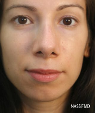 Primary Rhinoplasty Before & After Gallery - Patient 108174135 - Image 4