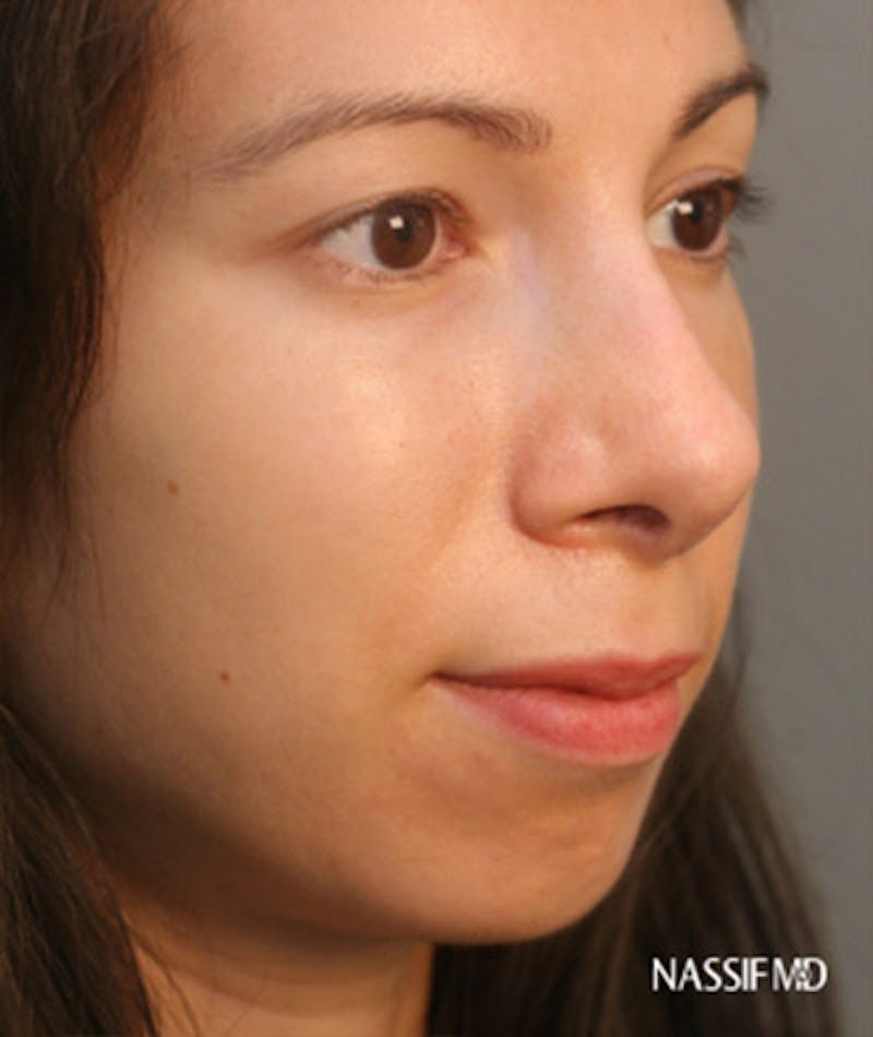 Primary Rhinoplasty Before & After Gallery - Patient 108174135 - Image 6