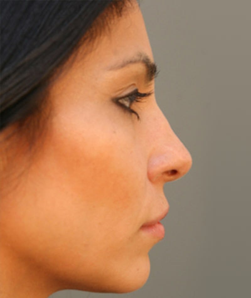 Primary Rhinoplasty Before & After Gallery - Patient 108174136 - Image 1