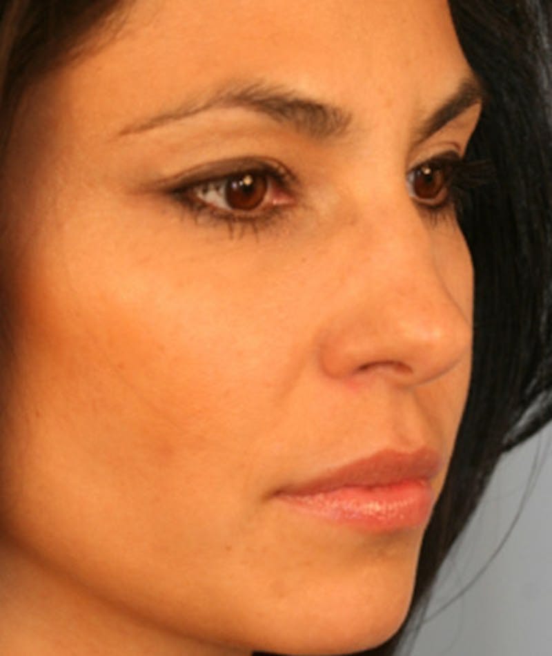 Primary Rhinoplasty Before & After Gallery - Patient 108174136 - Image 7