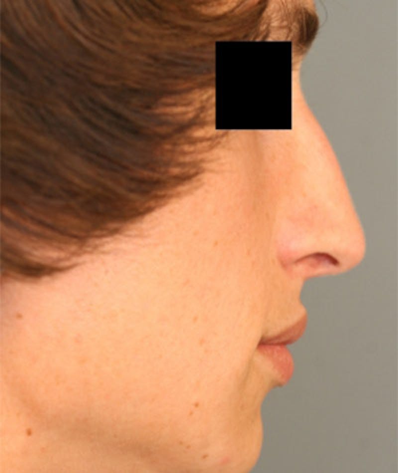 Primary Rhinoplasty Before & After Gallery - Patient 108174137 - Image 1