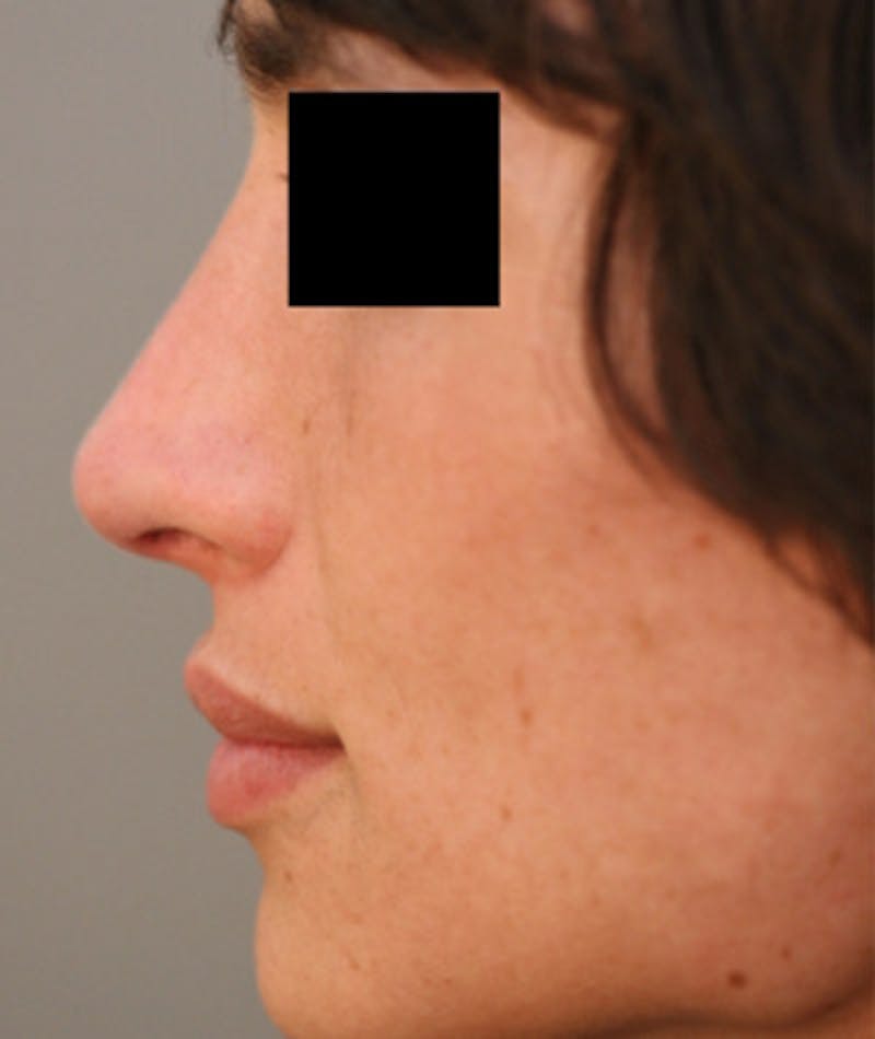 Primary Rhinoplasty Before & After Gallery - Patient 108174137 - Image 2