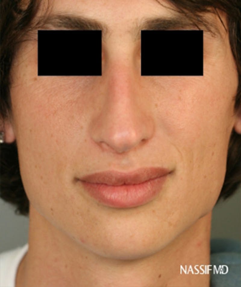 Primary Rhinoplasty Before & After Gallery - Patient 108174137 - Image 3