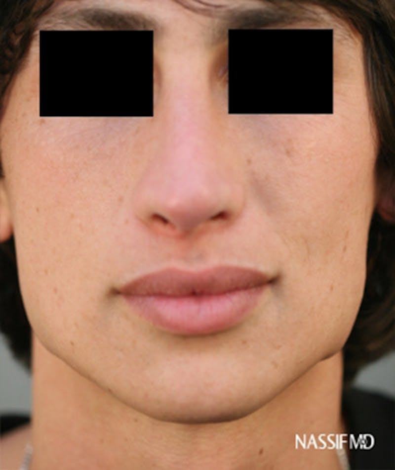 Primary Rhinoplasty Before & After Gallery - Patient 108174137 - Image 4