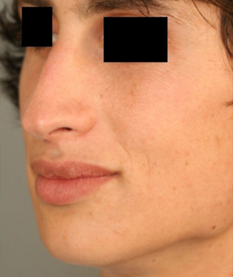 Primary Rhinoplasty Before & After Gallery - Patient 108174137 - Image 5