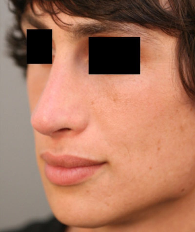 Primary Rhinoplasty Before & After Gallery - Patient 108174137 - Image 6