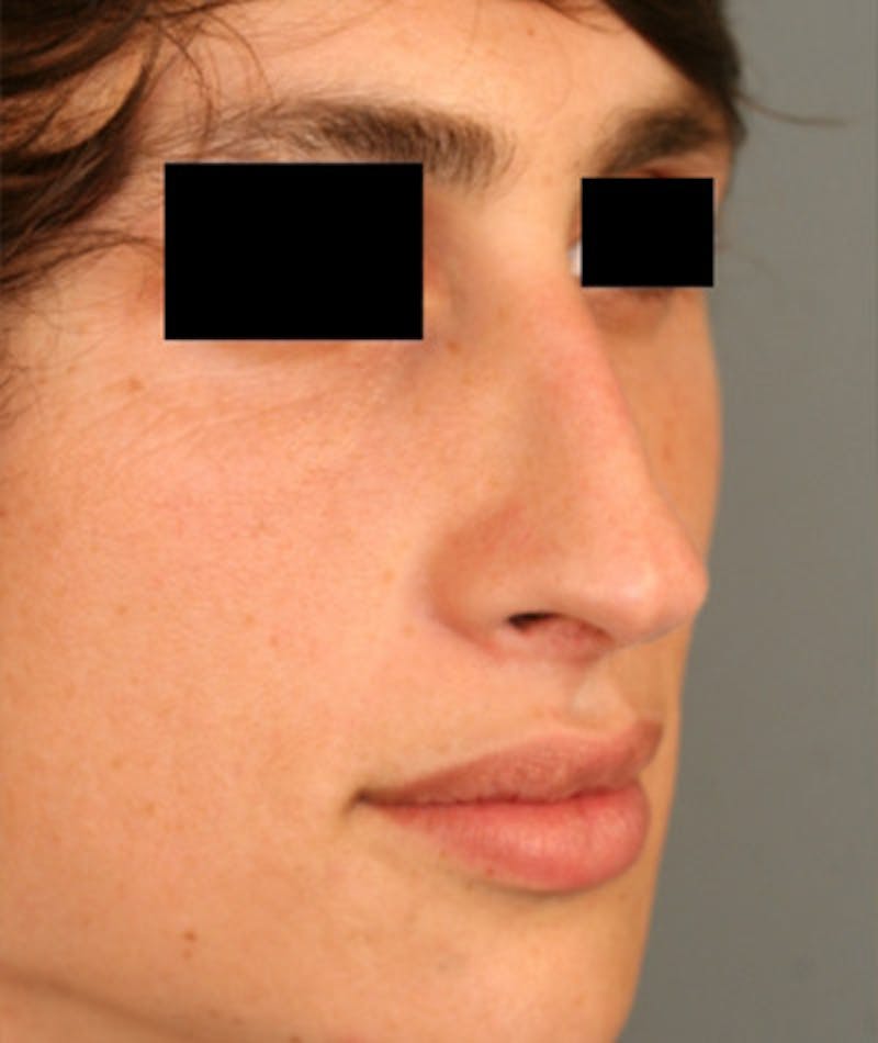 Primary Rhinoplasty Before & After Gallery - Patient 108174137 - Image 7