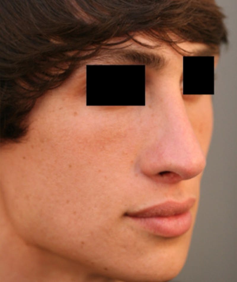 Primary Rhinoplasty Before & After Gallery - Patient 108174137 - Image 8