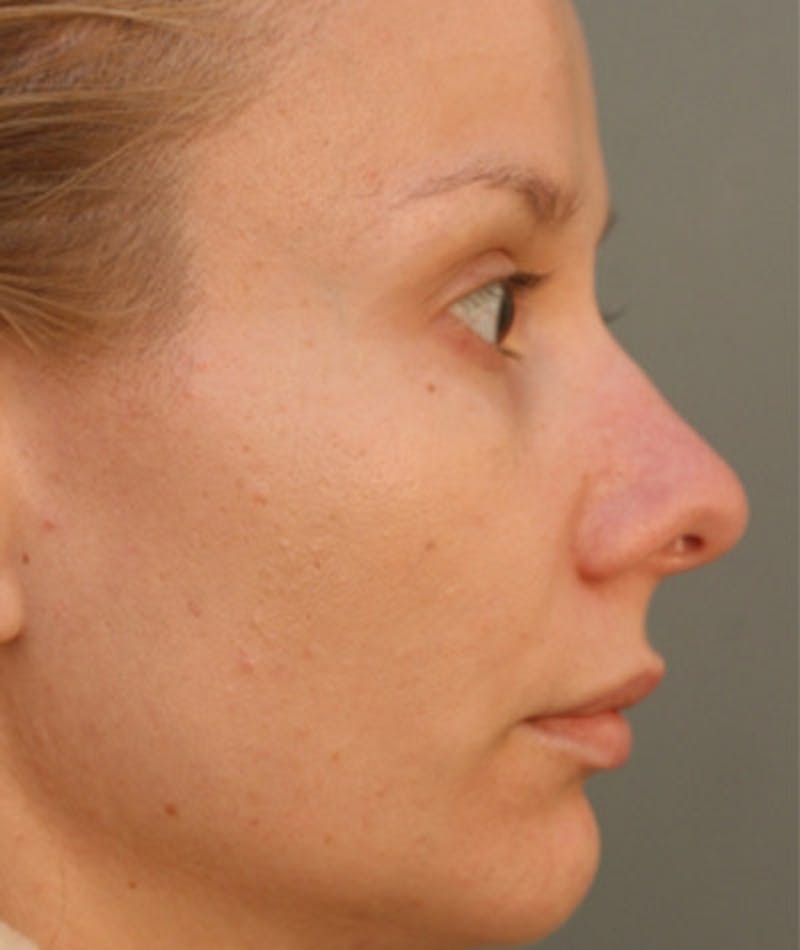 Primary Rhinoplasty Before & After Gallery - Patient 108174149 - Image 1