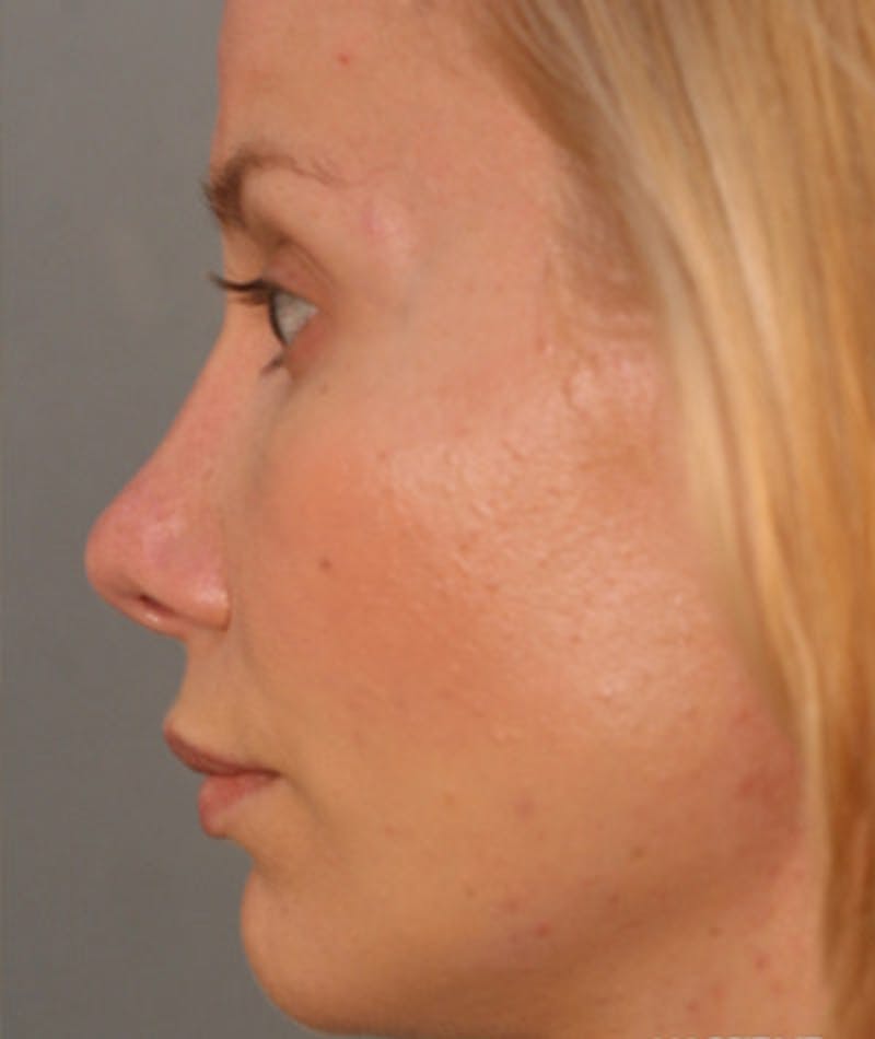 Primary Rhinoplasty Before & After Gallery - Patient 108174149 - Image 2
