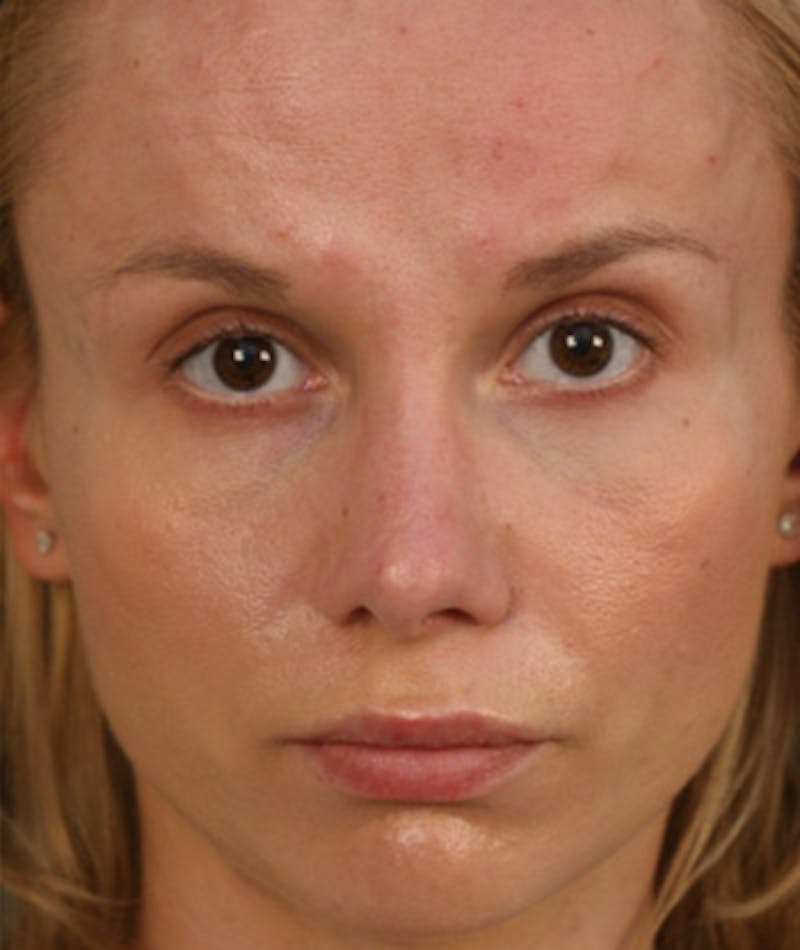 Primary Rhinoplasty Before & After Gallery - Patient 108174149 - Image 4