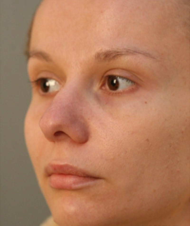 Primary Rhinoplasty Before & After Gallery - Patient 108174149 - Image 5