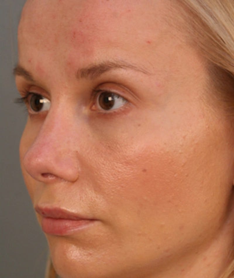 Primary Rhinoplasty Before & After Gallery - Patient 108174149 - Image 6
