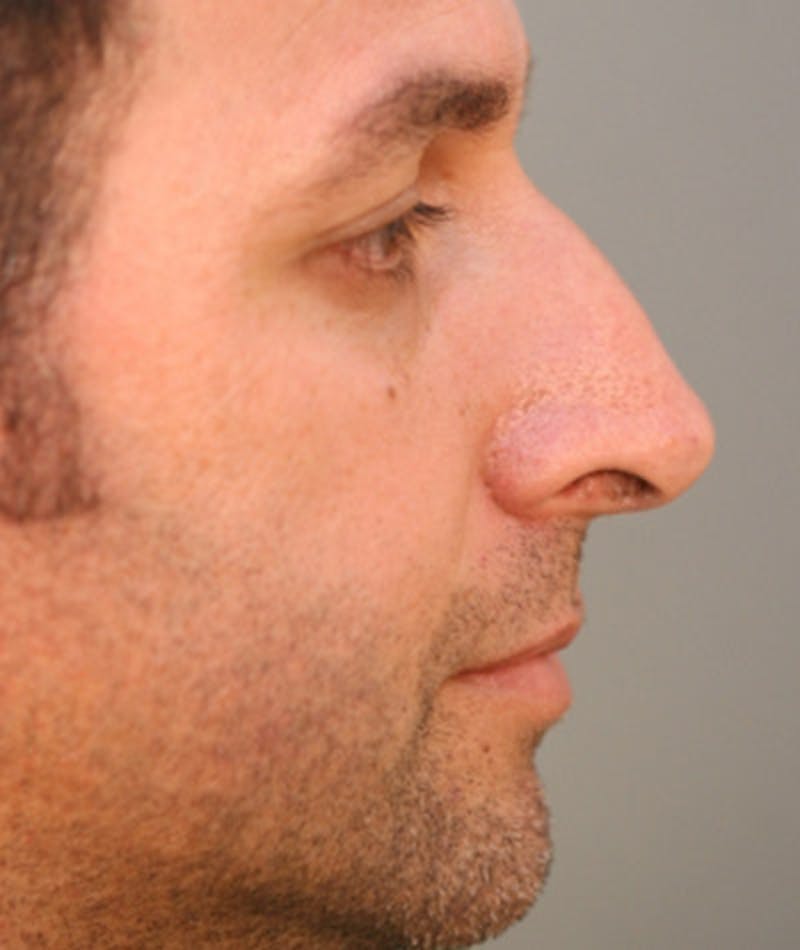 Primary Rhinoplasty Before & After Gallery - Patient 108174153 - Image 1