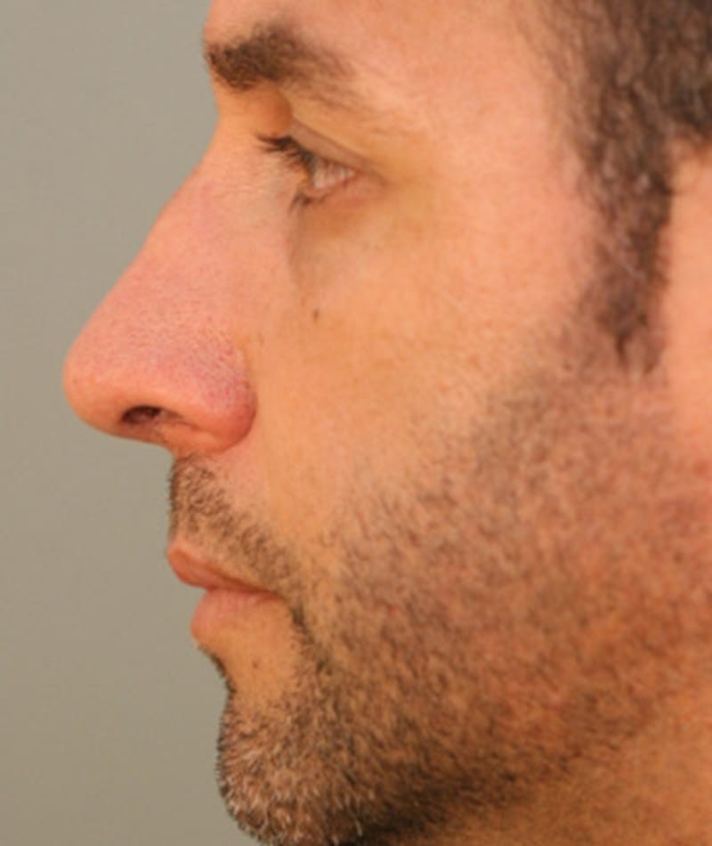 Primary Rhinoplasty Before & After Gallery - Patient 108174153 - Image 2