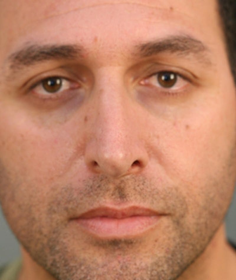 Primary Rhinoplasty Before & After Gallery - Patient 108174153 - Image 3