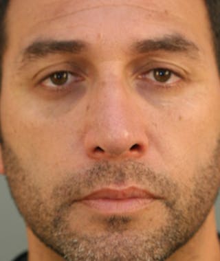 Primary Rhinoplasty Before & After Gallery - Patient 108174153 - Image 4