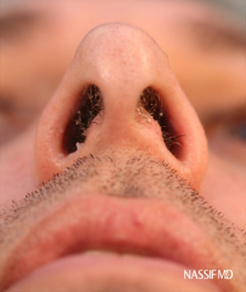 Primary Rhinoplasty Before & After Gallery - Patient 108174153 - Image 5