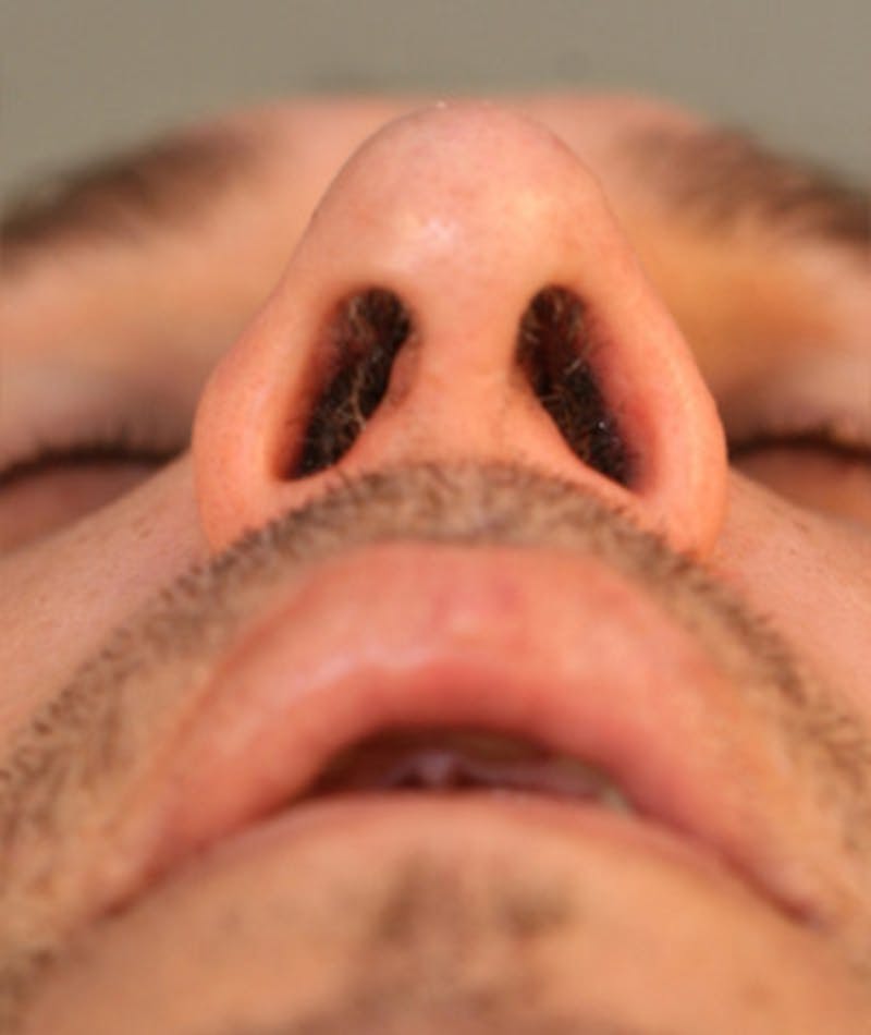 Primary Rhinoplasty Before & After Gallery - Patient 108174153 - Image 6