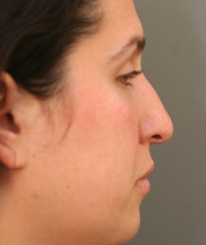 Primary Rhinoplasty Before & After Gallery - Patient 108174181 - Image 1