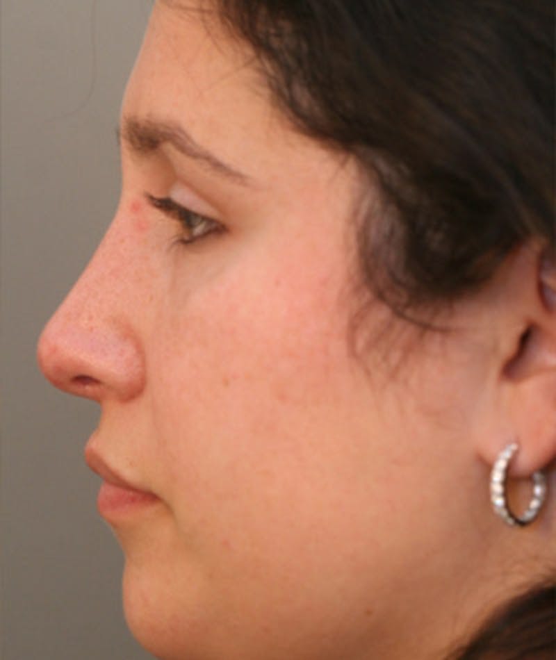 Primary Rhinoplasty Before & After Gallery - Patient 108174181 - Image 2