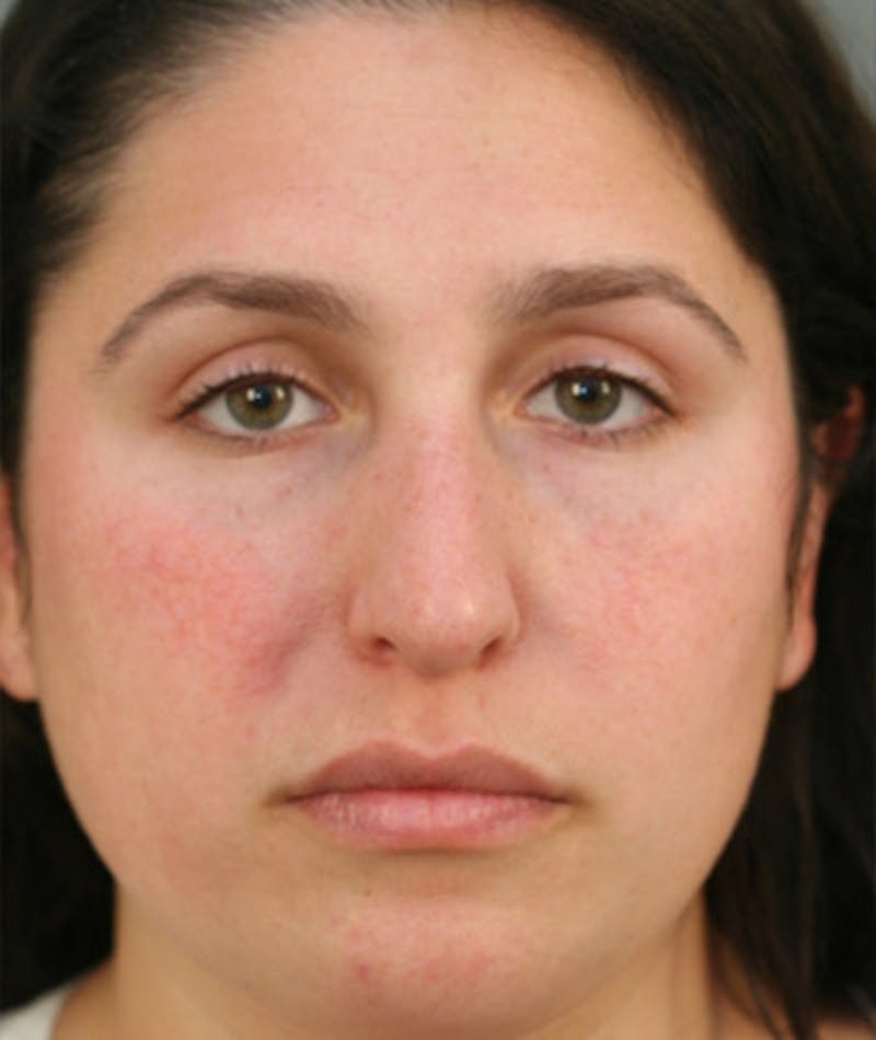 Primary Rhinoplasty Before & After Gallery - Patient 108174181 - Image 3
