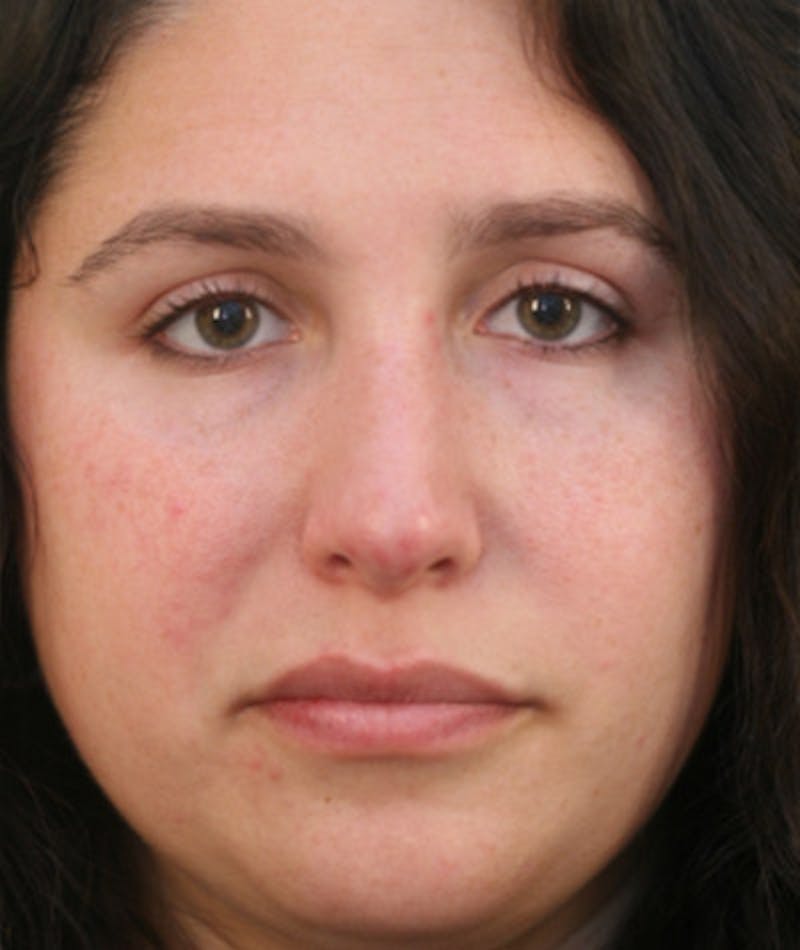 Primary Rhinoplasty Before & After Gallery - Patient 108174181 - Image 4