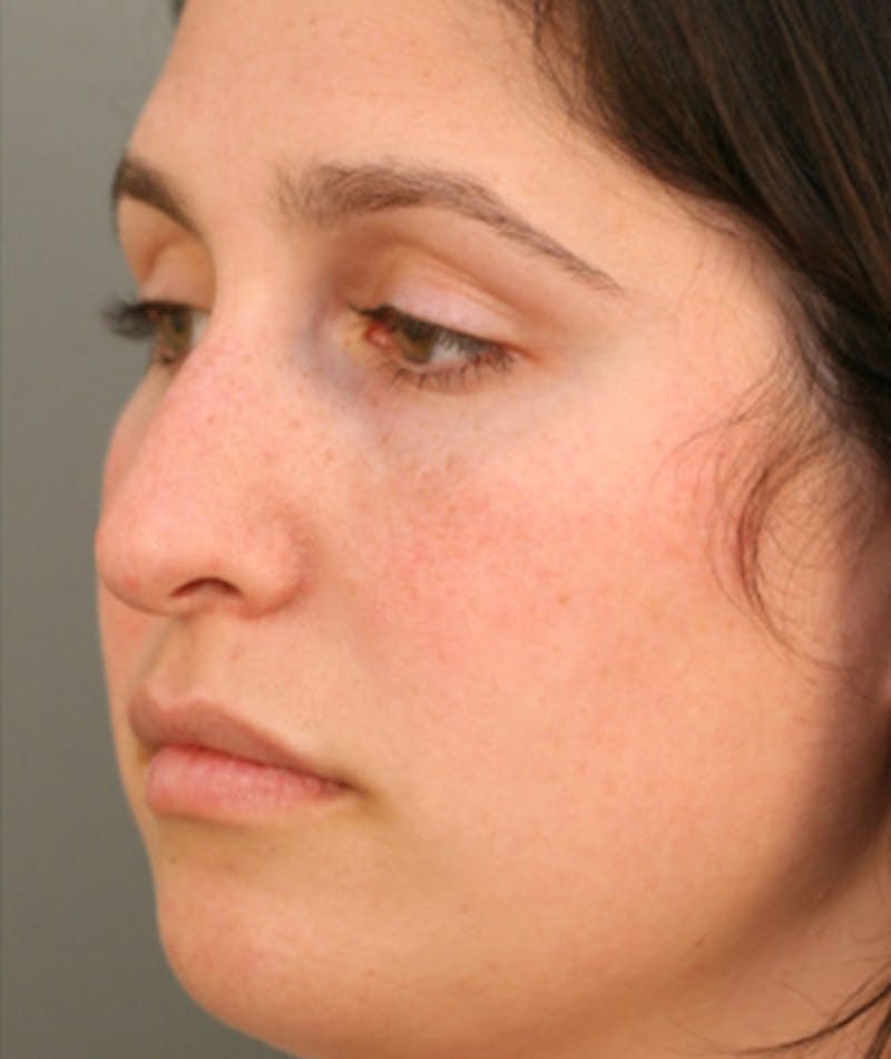 Primary Rhinoplasty Before & After Gallery - Patient 108174181 - Image 5