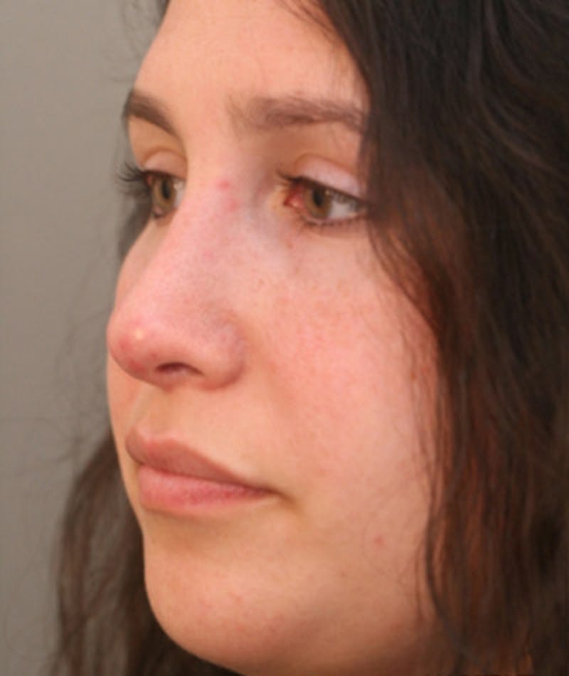 Primary Rhinoplasty Before & After Gallery - Patient 108174181 - Image 6