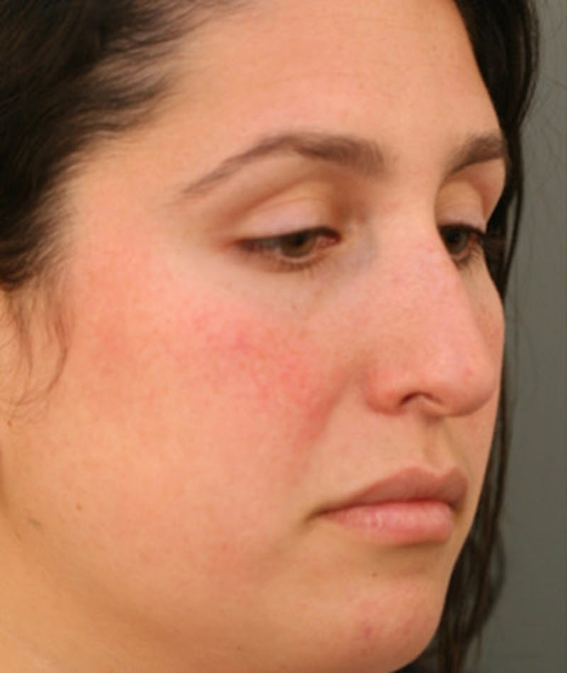 Primary Rhinoplasty Before & After Gallery - Patient 108174181 - Image 7