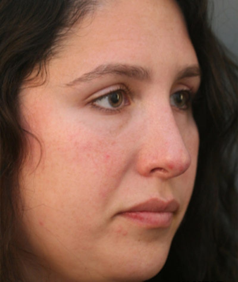 Primary Rhinoplasty Before & After Gallery - Patient 108174181 - Image 8