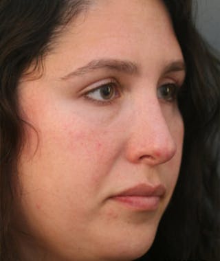 Primary Rhinoplasty Before & After Gallery - Patient 108174181 - Image 8