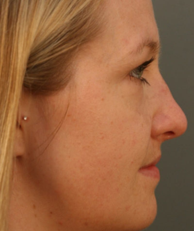 Primary Rhinoplasty Before & After Gallery - Patient 108174182 - Image 1