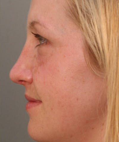 Primary Rhinoplasty Before & After Gallery - Patient 108174182 - Image 2